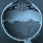 Ретинопатия на недоносеното