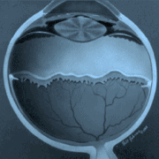 Ретинопатия на недоносеното