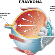 Глаукома