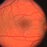 Диaбeтнaтa peтинoпaтия