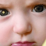 ретинобластома