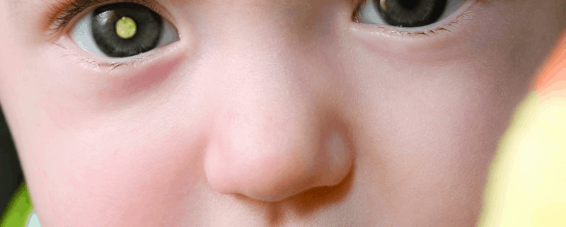 ретинобластома