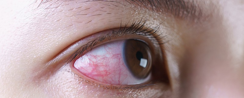 зачервени очи причини