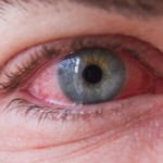 Алергичен конюнктивит