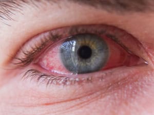 Алергичен конюнктивит