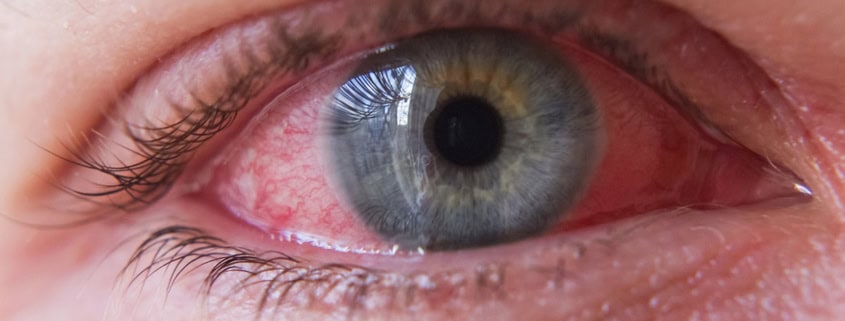 Алергичен конюнктивит