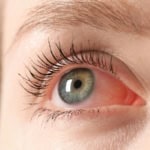 Заразен ли е конюнктивитът