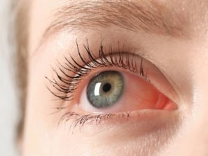 Заразен ли е конюнктивитът