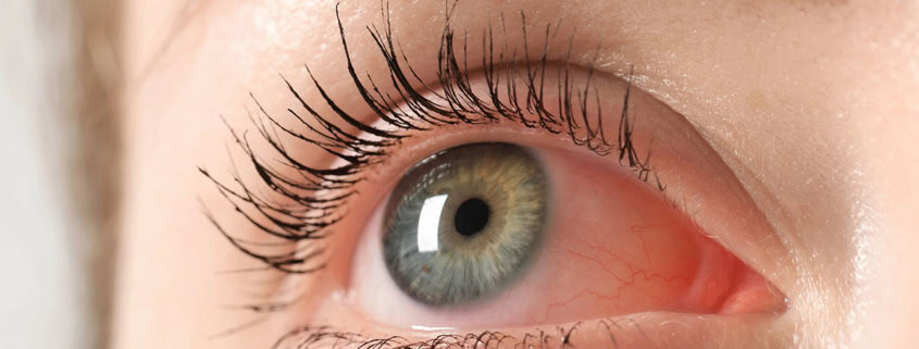 Заразен ли е конюнктивитът